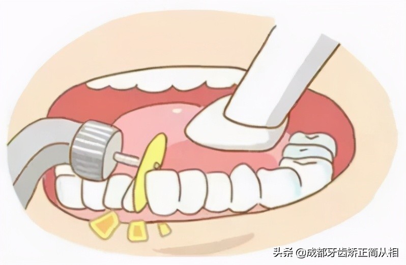 牙齿拥挤怎么矫正最快,下牙牙齿拥挤怎么矫正