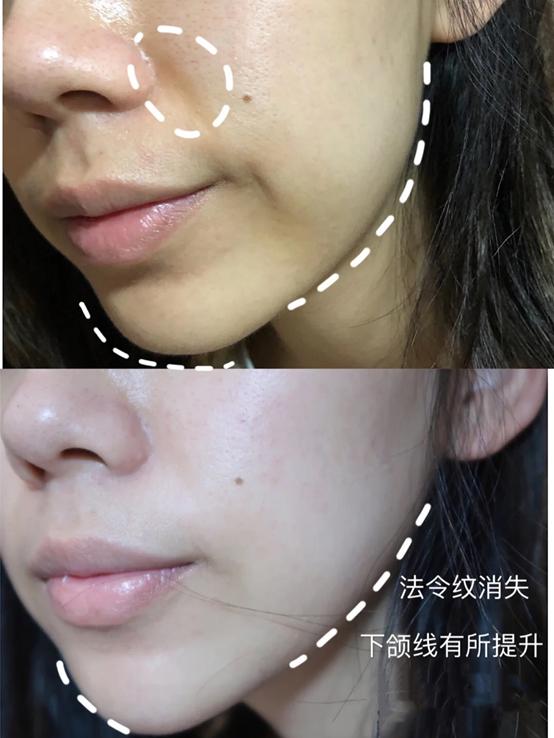 法令纹显老不用愁一招改善法令纹,一个小方法轻松改善法令纹