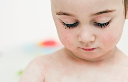 湿疹的日常护理注意事项,湿疹的护理方法有哪些