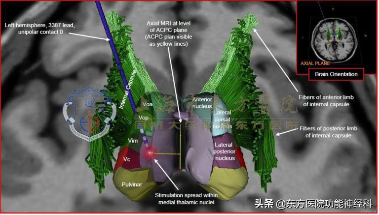 32岁女子患抑郁症坚持手术治疗,女白领抑郁症
