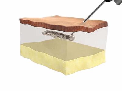 男人额头除皱用哪种方法好,额头除皱效果最好的方法