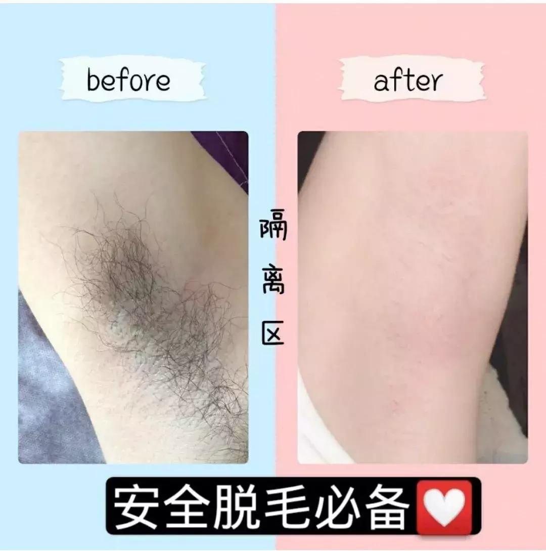 夏天最靠谱的脱毛攻略,脱毛现在最好的技术是