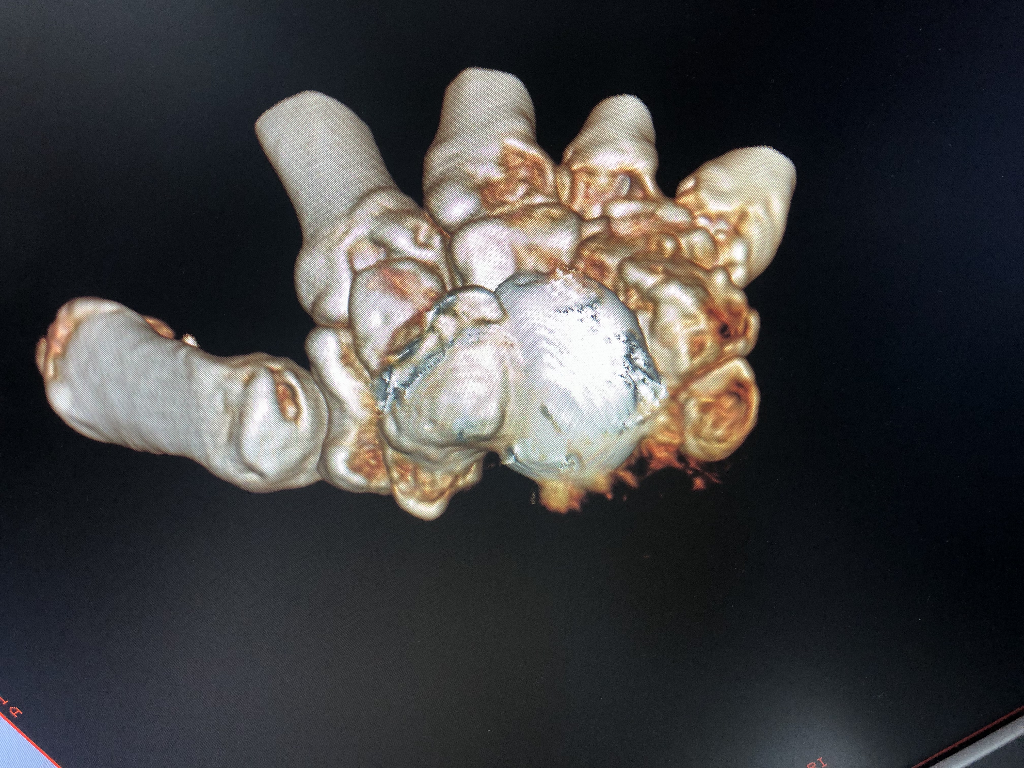 髋臼骨折3d打印效果怎么样,骨折后无法复位怎么办