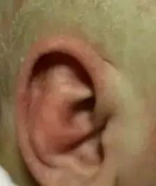 出生宝宝耳朵耳廓畸形判断,新生婴儿耳廓畸形圆耳