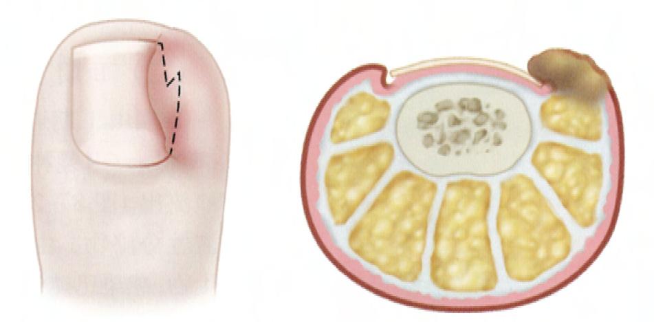 甲沟炎塞棉花能永久治疗甲沟炎吗,如何用棉花棒治疗甲沟炎