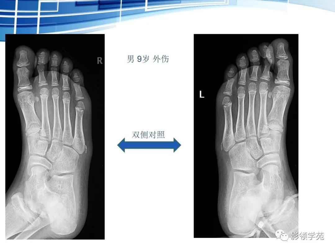 桡骨远端骨折引起尺骨变异,撕脱骨折一个月无明显骨痂形成