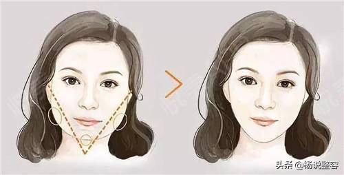 为什么会下颌突出,为什么下颌角突出