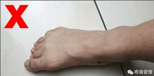 专门改善扁平足的运动,站着改善x型腿