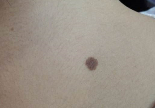 黑痣和黑痣区别图片,黑痣与一般痣癌变的概率