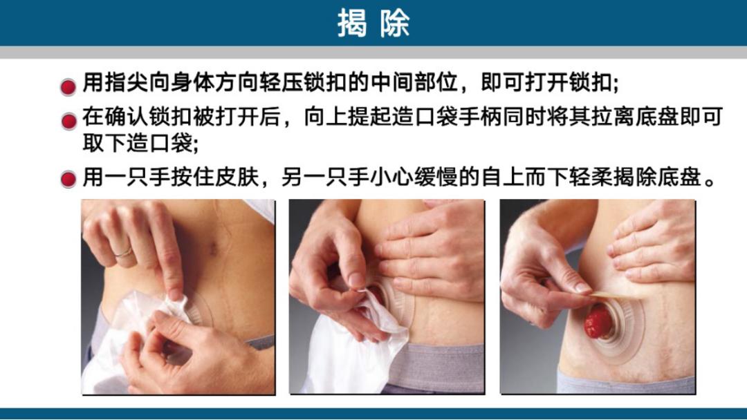 造口手术后多久复查一次,造口复查检查什么