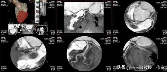 “躺平就好”四处求医愁煞人巧断病因封堵成功再登巅
