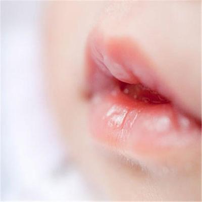 宝宝频繁“嘴角烂”，别当上火处理，而是要注意它