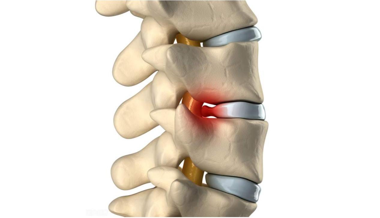 腰椎间盘的治疗经历,未来治疗腰椎间盘最新办法