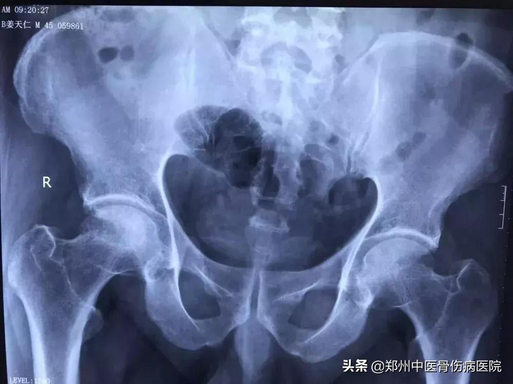骨坏死是早期治疗好还是晚点治好,骨坏死预后治愈情况