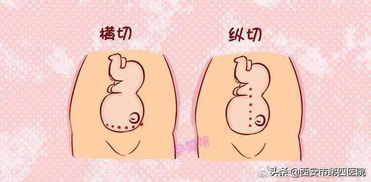 什么情况下选择剖腹产,什么情况可以选择剖腹产