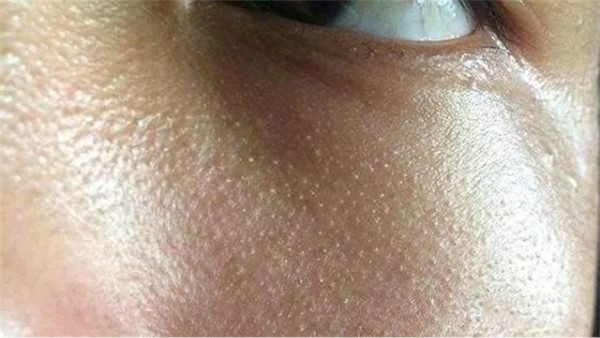 脸上频繁长脂肪粒怎么办,脸上长脂肪粒怎么办有效