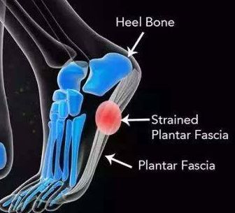 跑步跑到足跟痛，运动生涯要报废？