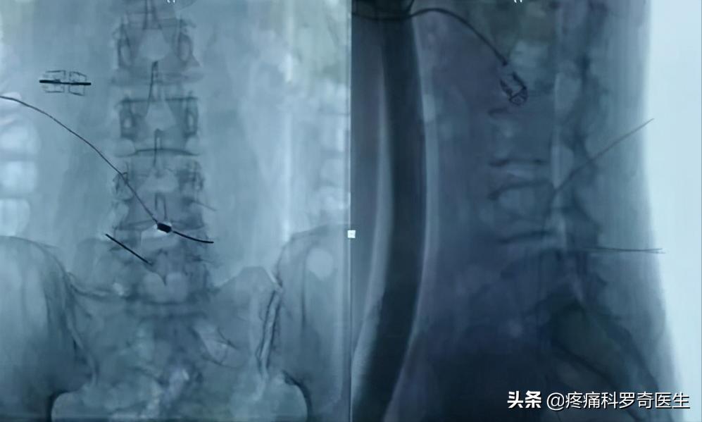 你的腰痛是怎么回事,你的腰痛是哪种