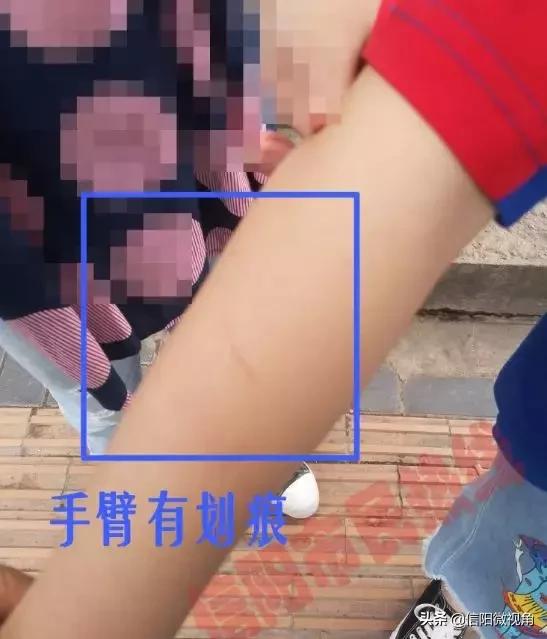 八岁女童被老师打致残,8岁女童被老师打残