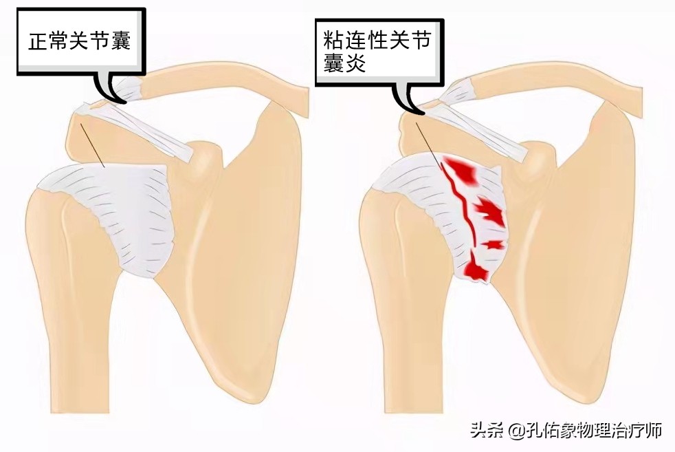 手指肿胀有硬硬的感觉,手指有结节有僵硬疼痛是什么病