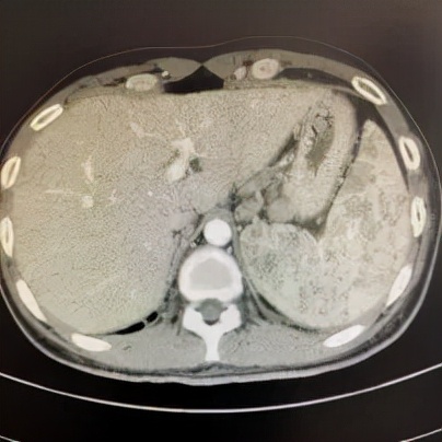 感觉身体淋巴结游走性疼痛,全身多处炎性淋巴结