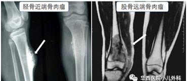 孩子老喊腿疼是怎么了,孩子老是喊腿疼该怎么检查