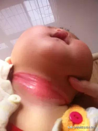 婴幼儿脖子淹了破皮了怎么办,脖子淹破皮了抹香油管用吗