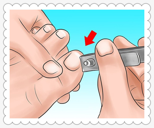 甲沟炎处理视频动画,沉浸式处理甲沟炎