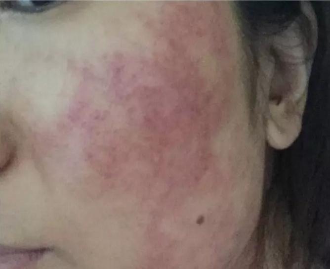 热拉提热玛吉fotona4d怎么选,热拉提抗衰