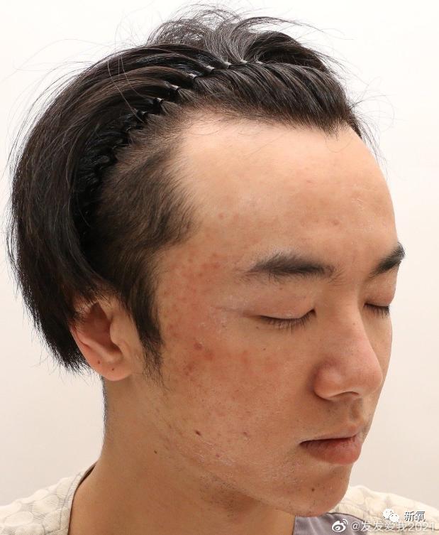 华晨宇整前整后对比,华晨宇最近又整脸了么