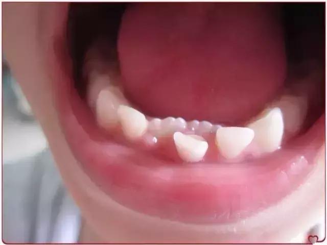 儿童换牙新牙长出旧牙还没掉,6岁孩子旧牙未掉又长出新牙