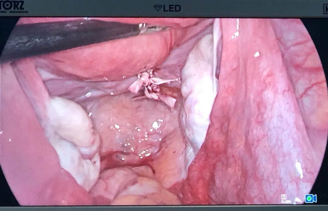 市一技术｜新生命的保护圈——我院开展腹腔镜下宫颈环扎