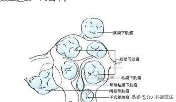 子宫出血、尿频和尿痛、月经增多，警惕得了子宫肌瘤的5大症状