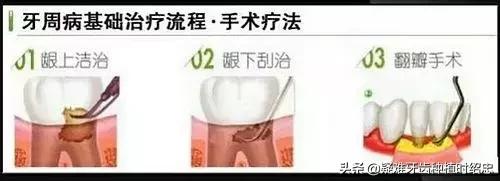 牙周炎导致牙齿松动严重怎么办,重度牙周炎导致牙齿松动