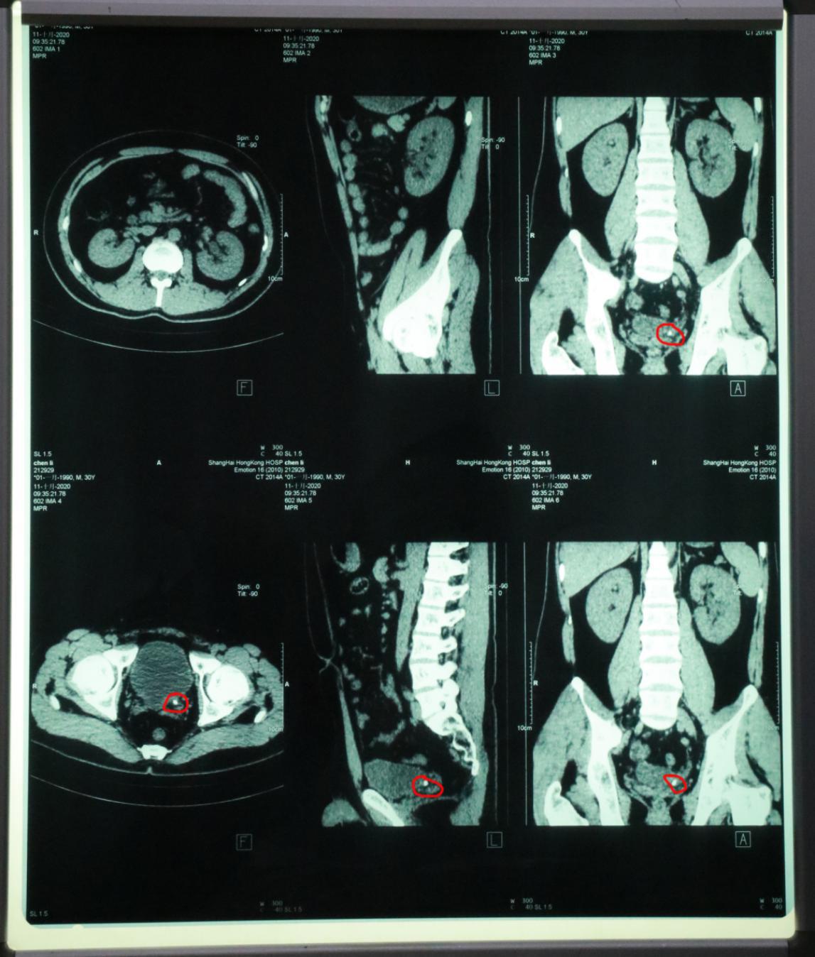 被扁桃体结石折磨到崩溃,被结石性胆囊炎折磨了一个月