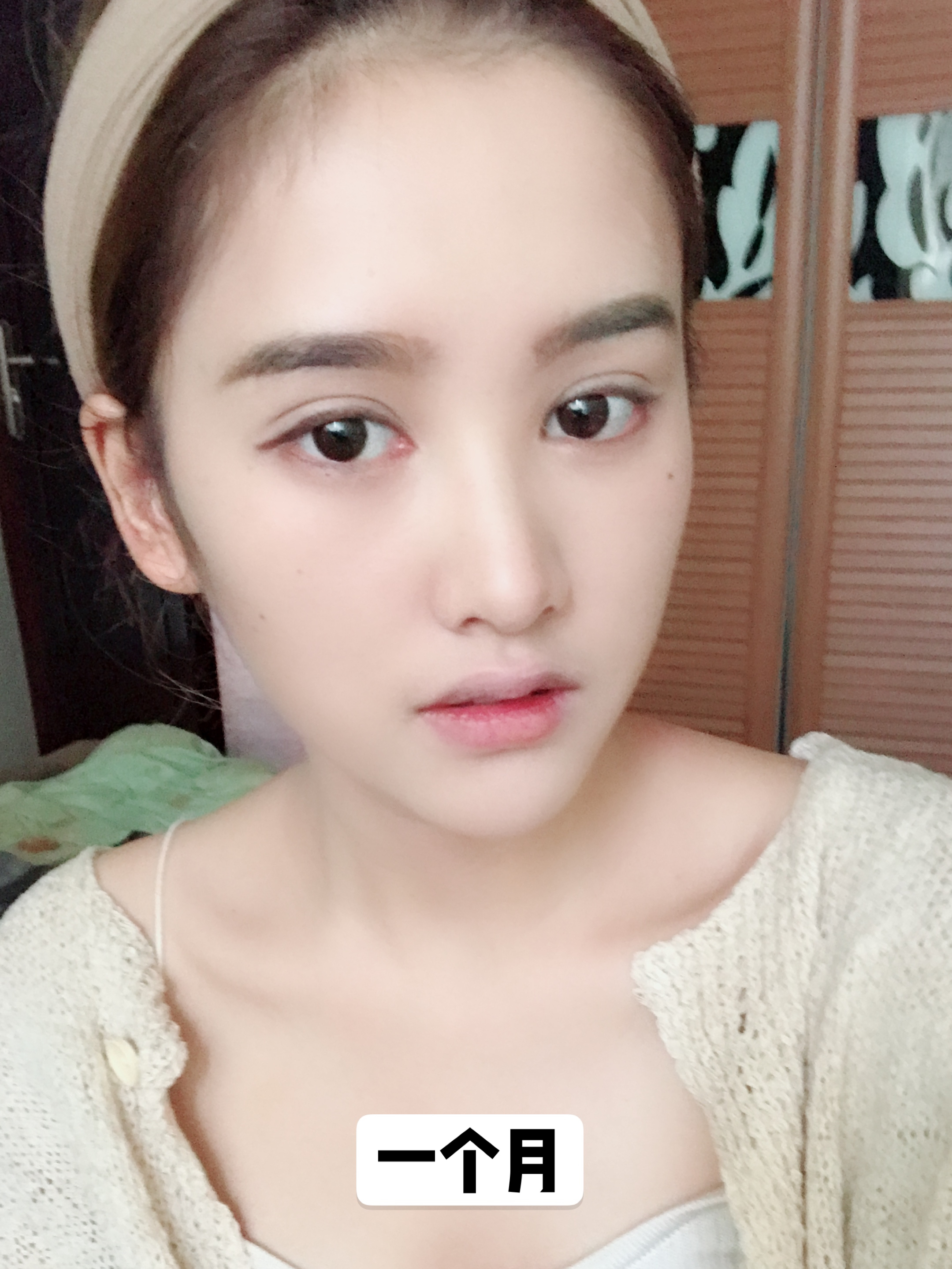 做了埋线双眼皮后悔了,做完双眼皮后悔的多吗