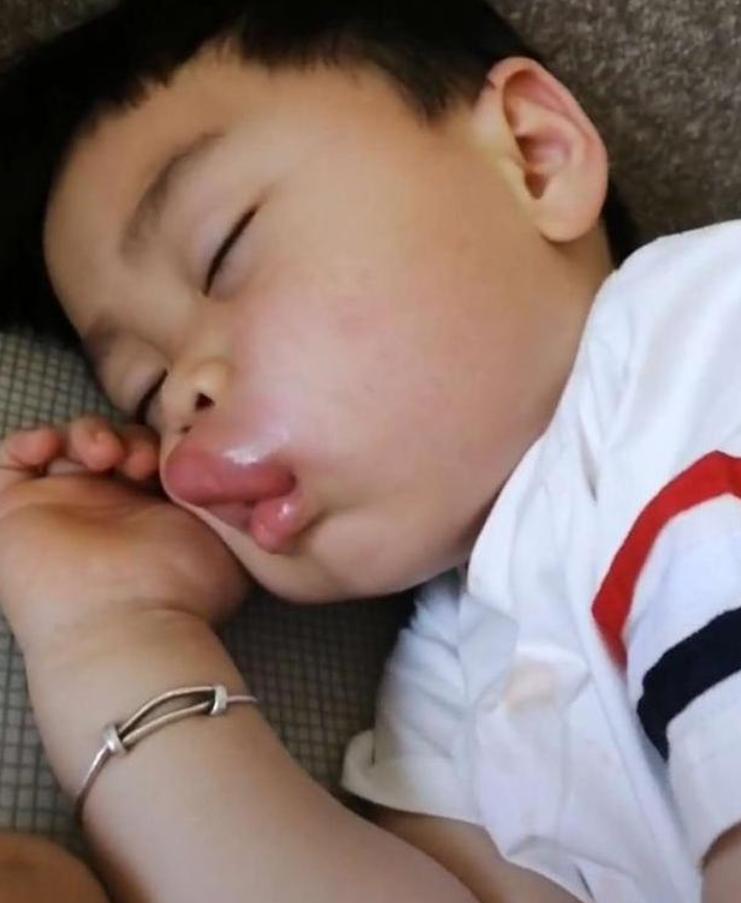 小孩嘴巴肿了一块,孩子一大早嘴巴肿了