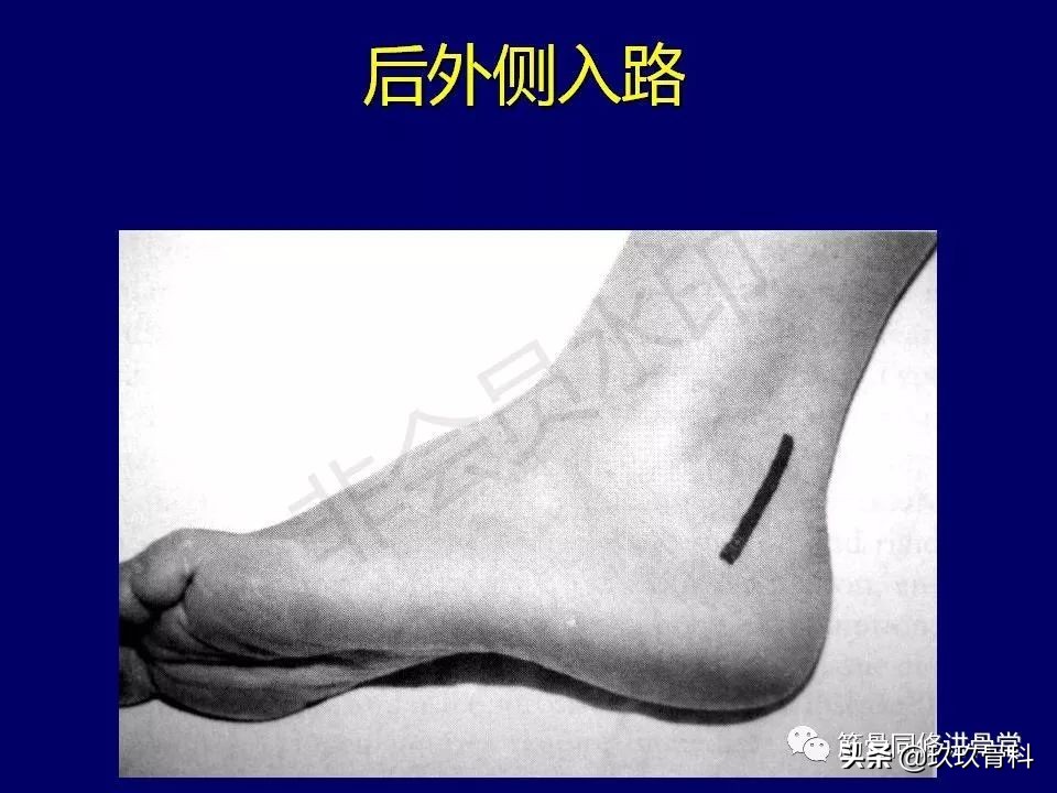 距骨骨折后遗症,距骨骨折怎么办