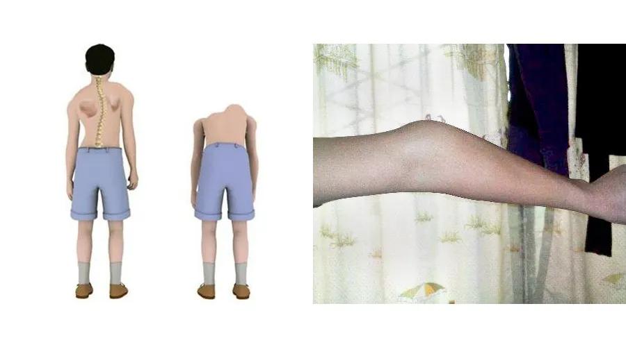 腰椎结核有哪些症状,腰椎结核手术2年开春腰疼