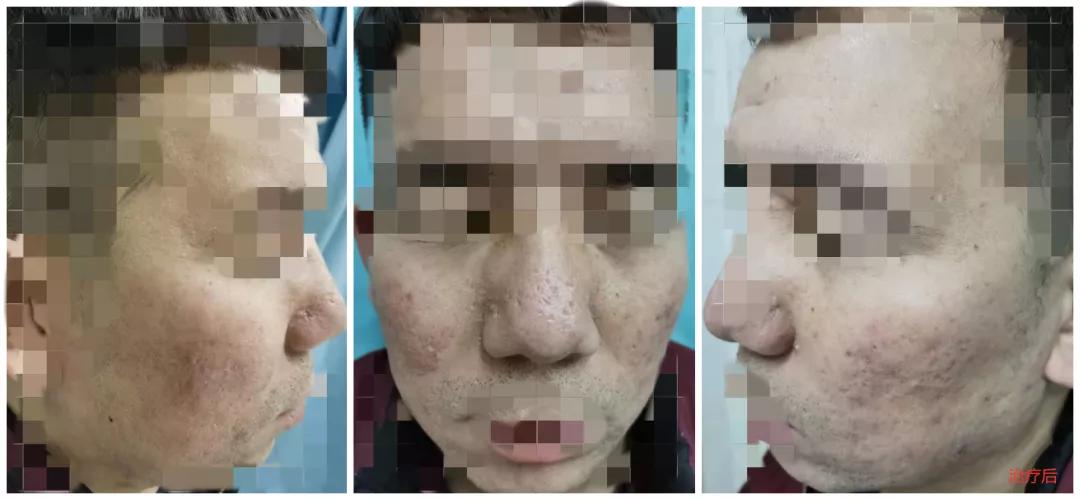 治痘疮最好的办法,战痘的最佳治疗方案