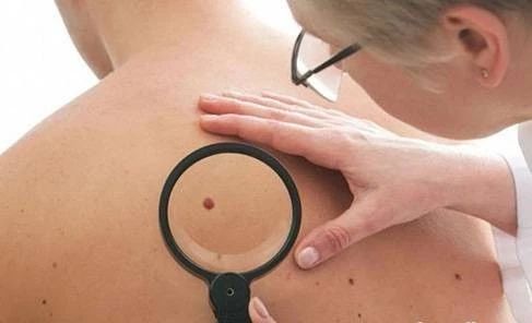 出现卫星灶痣症状就是癌症了吗,身上长痣怎么查是不是癌症