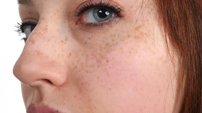 脸上有斑脏腑有瘀中医教你巧化斑,脸上起斑中医如何调理