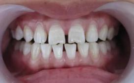 牙签会把牙缝越剔越大,经常剔牙会使牙缝越剔越大吗