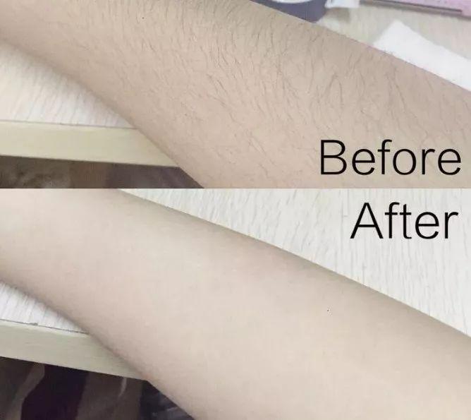 美白脱毛永久有效的产品,大家有什么好的永久脱毛推荐