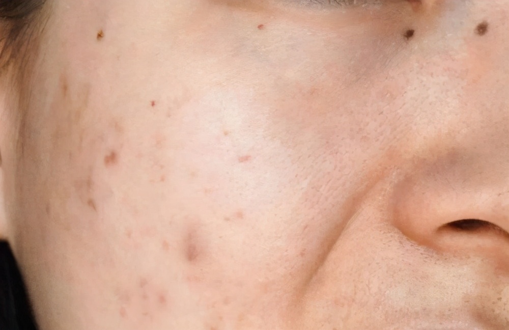 黑痘印和红痘印有什么区别,脸上红色痘印黑色痘印