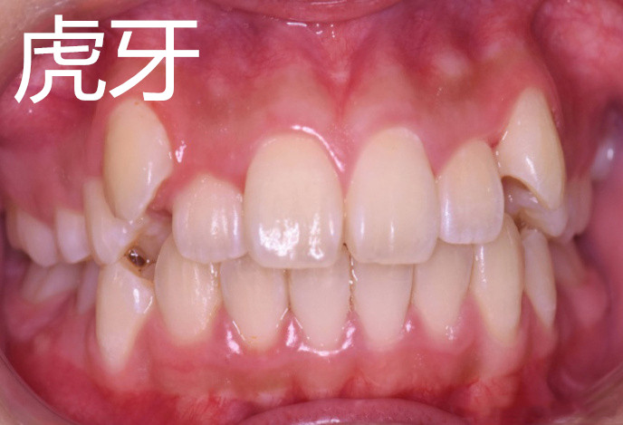 30岁了还可以做牙齿矫正吗,30岁还可以做牙齿矫正吗