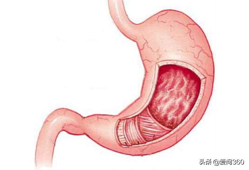 保护胃黏膜修复胃粘膜 (胃黏膜受损如何修复胃黏膜)