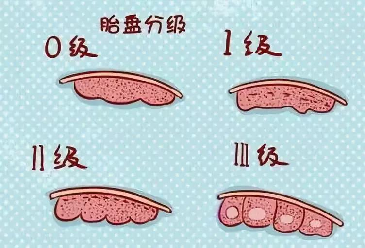 妇科b超能查出有没有宫腔粘连吗,孕期做b超能检查出来什么
