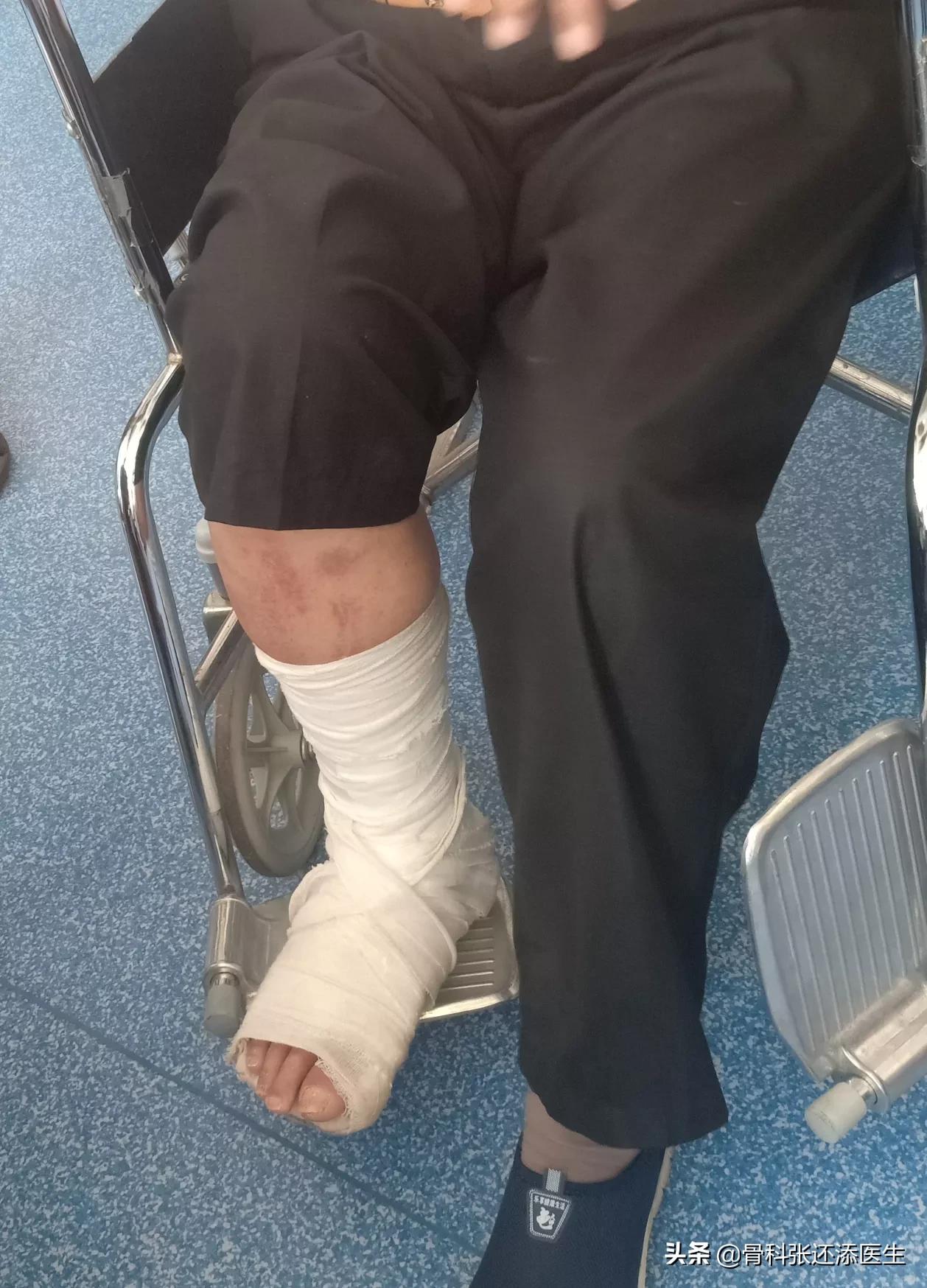 骨折打石膏后怎么康复训练,骨折打石膏后如何康复锻炼