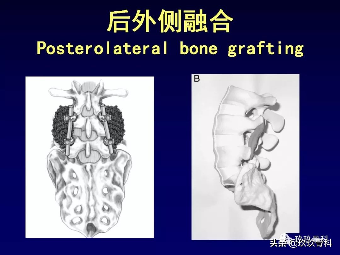 腰椎不稳最坏的结果,腰椎不稳的最佳治疗方法